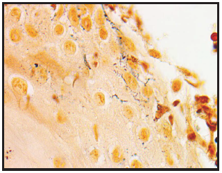 Figura 3. Caso 1. Anatomía patológica. Coloración de Warthin-Starry. Elementos espiralados tipo espiroquetas